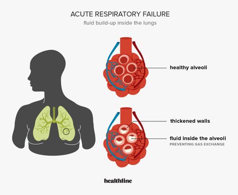 Acute Respiratory Failure, Respiratory Failure, Arterial Blood Gas, Mechanical Ventilation, Aesthetic Birthday, Birthday Pics, Chronic Obstructive Pulmonary Disease, Breathing Problems, Nursing School Notes