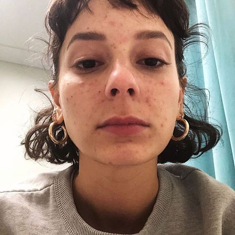 Woman, 25, left with inflamed face thanks to ‘decade-long battle with compulsive skin picking’ disorder Picking Disorder, Acne Pictures, Skin Picking Disorder, Alyssa Coscarelli, Back Acne Remedies, Skin Picking, Acne Prone Skin Care, Inflamed Skin, Bad Acne