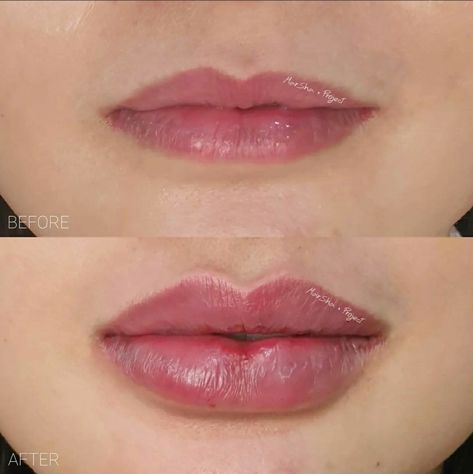 Heavy Lower Lip Filler, Minimal Lip Fillers, Lip Filler Technique, Heart Shaped Lips, Lip Augmentation, Lip Filler, Lip Enhancement, Lower Lip, Bottom Lip