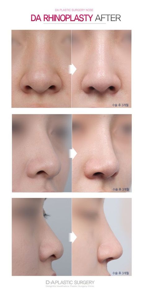 Korean Nose Job Before After, Korean Rhinoplasty Before After, Nose Rhinoplasty Before After, S Line Nose, Rhinoplasty Before After, Korea Rhinoplasty, Korean Nose Job, Nose Operation, Korean Rhinoplasty