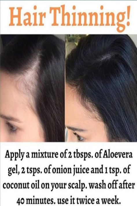 Hair Fall Remedy, Homemade Hair Treatments, Hair Care Remedies, Hair Growth Secrets, Natural Skin Care Remedies, Hair Care Recipes, Natural Face Skin Care, Hair Growing Tips, Good Skin Tips