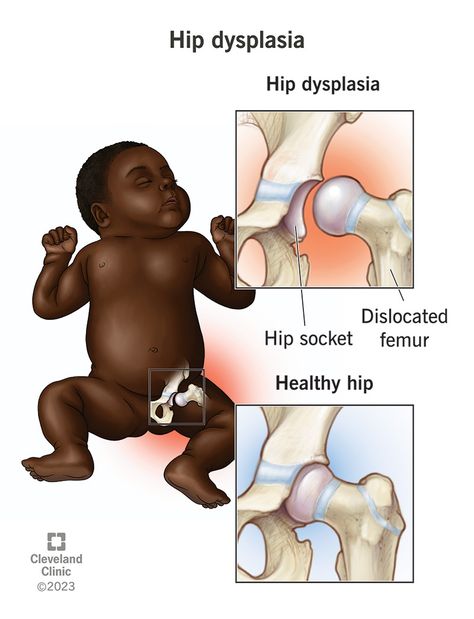 Does my baby have hip dysplasia? Hip Dislocation, Hip Problems, Hip Dysplasia, Hip Mobility, Cleveland Clinic, Signs And Symptoms, Medical Center, The Signs, Medical Professionals