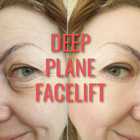 Pixie Tip Lift Nose Filler, Botox Nose Tip Lift, Deep Plane Facelift, Deep Plane Facelift Before And After, Failed Plastic Surgeries, Cheek Fat, Facelift Before And After, Non Surgical Facelift, Facelift Procedure