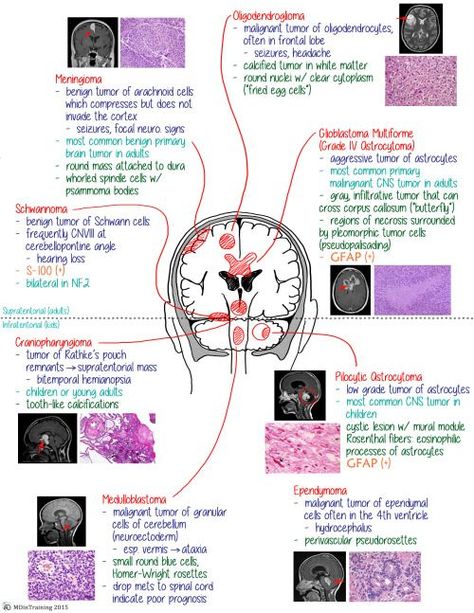 Clinical Pathology, Radiology Student, Brain Tumors, Medicine Notes, Medical School Life, Medical Laboratory Science, Medical Student Study, Medical School Motivation, Medicine Student