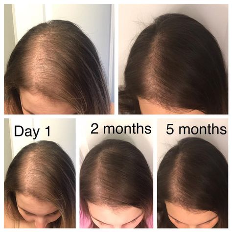 Hair Regrowth Women, Hair Growth Formula, Healthy Natural Hair Growth, Vegan Hair Care, Hair Secrets, Endocannabinoid System, Monat Hair, New Hair Growth, Vegan Hair