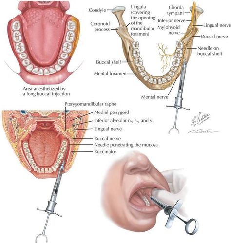 Dental Anesthesia, Local Anesthesia, Future Dentist, Dental Assistant Study, Registered Dental Hygienist, Dental Hygiene Student, Dental World, Female Dentist, Remedies For Tooth Ache