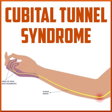 A Review of Cubital Tunnel Syndrome Cubital Tunnel Syndrome, Nerve Conduction Study, Ulnar Nerve, Elbow Braces, Elbow Pain, Degenerative Disease, Therapy Equipment, Sports Medicine, Ultrasound