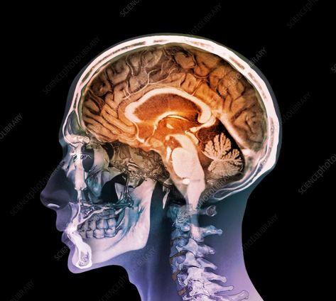 Human head. Coloured composite image of a magnetic resonance imaging (MRI) scan of the brain and 2D and 3D computed tomography (CT) scans of the head and neck of a 35 year old patient. The highly folded area of the brain is the cerebrum, which is responsible for conscious thought, emotion and voluntary movement. The orange arch beneath it is the corpus callosum, which facilitates communication between the hemispheres. At bottom right is the cerebellum, which controls muscle coordination and bala Brain Structure, Limbic System, Brain Scan, Mri Scan, Magnetic Resonance Imaging, Ct Scan, Magnetic Resonance, Human Head, Science Photos