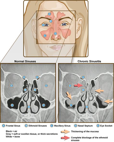 Front view illustration and side-by-side CT scans of normal and chronic sinusistis. Labeled: frontal sinus, ethmoid sinuses, maxillary sinus, nasal septum, eye socket. Credit: NIAID