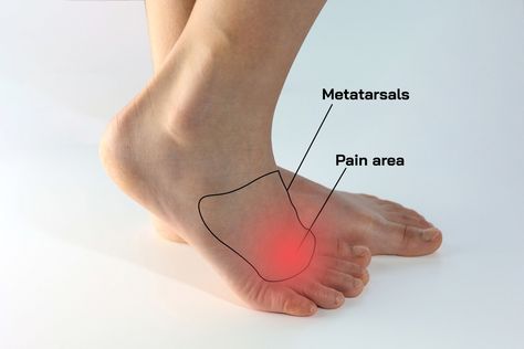 5 Exercises for Morton's Neuroma: Alleviate Your Foot Pain - Custom Orthotics Blog - Upstep Morton Neuroma Exercises, Foot Exercises For Pain, Ankle Mobility Exercises, Mortons Neuroma, Toe Exercises, Soleus Muscle, Daily Drills, Morton's Neuroma, Arthritic Pain