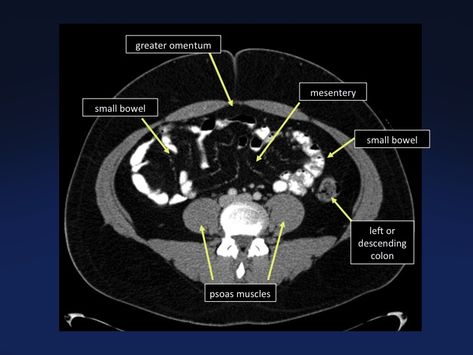 Anatomy Of The Body, Mri Brain, Computed Tomography, Psoas Muscle, Medical Illustrations, Ct Scan, Medical Imaging, Uni Life, Body Anatomy