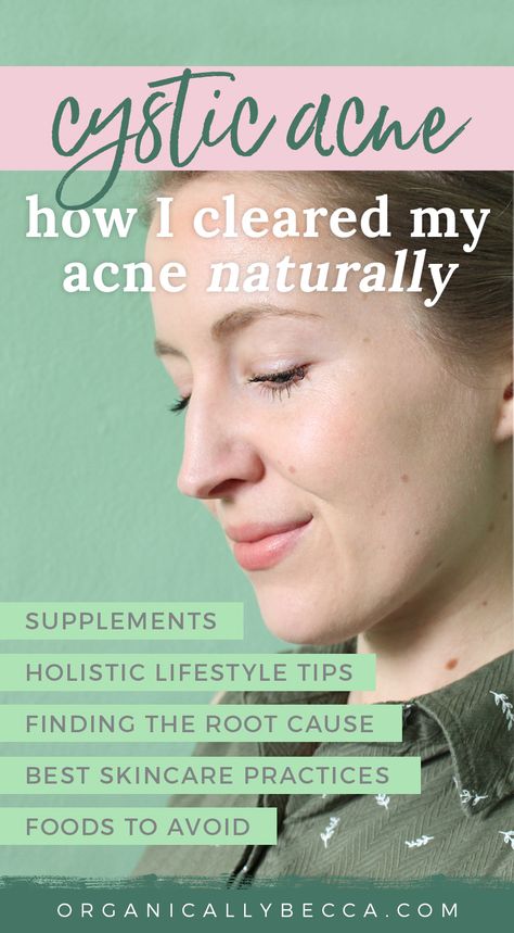 Clear Acne Naturally, Diet Products, I Healed, Oil Cleansing Method, Acne Diet, Forehead Acne, Facial Face, Oil Cleansing, Prevent Pimples