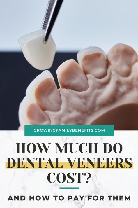 Dreaming of dental veneers but scared of the cost? Don't worry! Dental veneers can be expensive, but there are plenty of financing options to make them affordable. Whether it's monthly payment plans or no-credit-check alternatives like FSA financing and clip-in veneers, we've got the info you need. Find out the cost differences between porcelain veneers and composite veneers, get the details on the process, and learn how to afford those perfect teeth. Healthy Teeth Activities, Perfect Teeth Braces, Healthy Teeth Whitening, Affordable Dental Implants, Composite Veneers, Veneers Teeth, Porcelain Veneers, Perfect Teeth, Dental Veneers