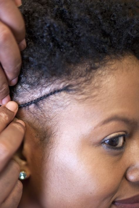 What Is Traction Alopecia? Traction Alopecia, Tight Braids, Breaking Hair, Keri Russell, Lisa Rinna, Hair Growth Serum, Braids With Extensions, Michelle Pfeiffer, Hair Problems