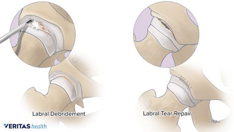 Surgery for Repairing a Torn Hip Labrum Torn Hip Labrum, Snapping Hip Syndrome, Torn Labrum, Shoulder Dislocation, Hip Injuries, Hip Problems, Hip Surgery, Types Of Surgery, Hip Pain