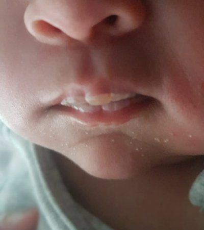 Blisters on a newborn's lips are commonly referred to as "milk blisters or sucky blisters". They happen mostly in breastfed babies. Most bottle fed babies don't get them They aren't painful for the child and even help the baby latch properly during feeding. Lip Blister, Milk Blister, Mouth Blisters, Blister On Lip, Baby Lips, Breastfed Baby, Baby Center, Canon Lens, Bottle Feeding