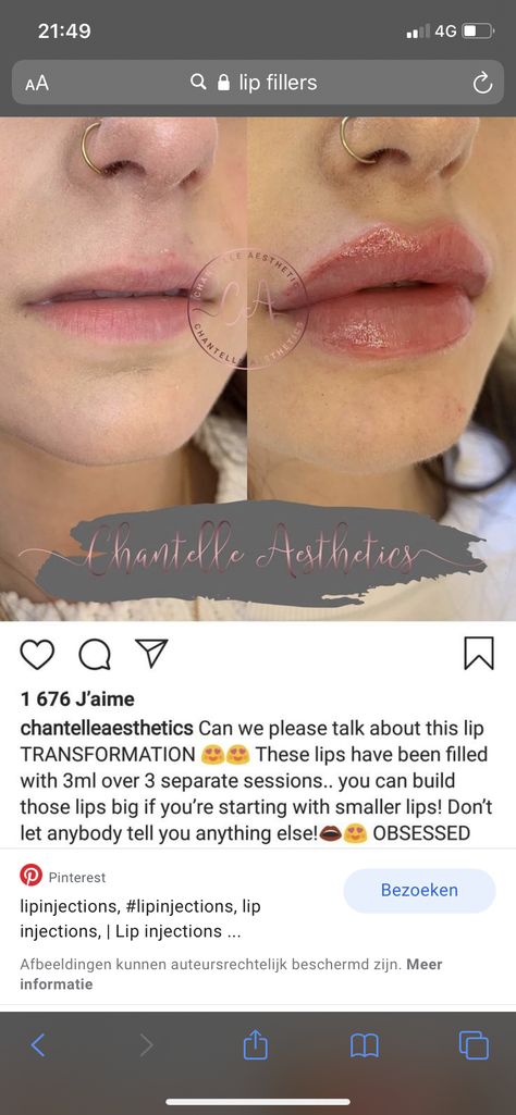 Small Lips Aesthetic, Lip Fillers Juvederm, 1ml Lip Filler, Lip Job, Face Plastic Surgery, Lip Surgery, Lips Inspiration, Botox Lips, Aesthetic Dermatology