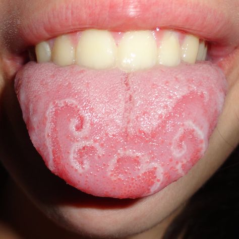 Name: geographic tongue Cause: etiology unknown Characteristics: loss of papillae created red lesions that vary in shape, size, and sensation Tx recommendations: does not require medical tx, best advice is to refrin from consuming acidic foods as it may irritate the papilla on tongues surface White Tongue, Red Tongue, Kedokteran Gigi, Tongue Health, Green Food Coloring, Nail Health, Oral Hygiene, Vitamin B, Oral Health