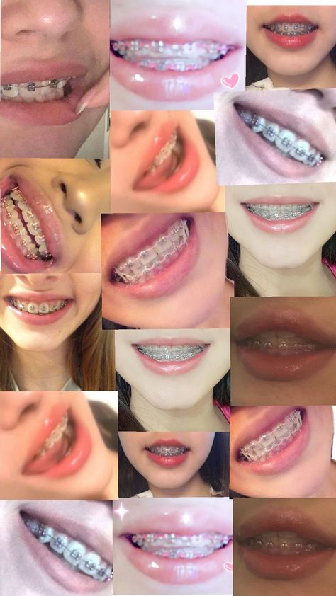 Perfect Teeth Braces, Braces Transformation, Braces Food, Cute Braces Colors, Braces Tips, Getting Braces, Cute Braces, Clear Braces, Brace Face