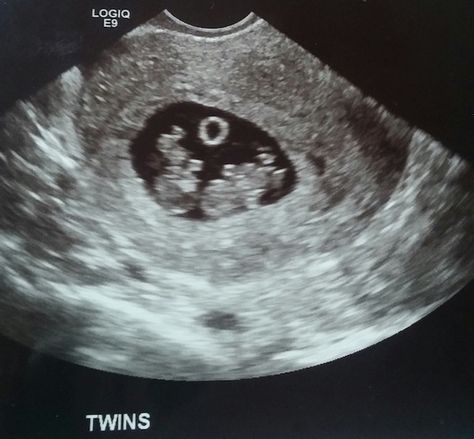 Are you pregnant with twins and wondering about what to do during the twins first trimester? We've got a great checklist to get you started! Pregnant Twins, First Trimester Checklist, Twins Ultrasound, 3 Months Pregnant, Twin Pregnancy Belly, Baby Ultrasound Pictures, Trimester Checklist, Twins Pregnancy, Pregnant With Twins