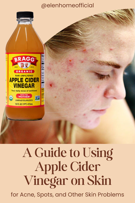 How to use apple cider vinegar on skin for acne, spots and other skin problems. #facetoner #beforeandafter #skincare #howtouse #ACVskincare Apple Cider Vinegar For Face, Apple Cider Vinegar For Acne, Power Of Nature, Acne Spots, Toner For Face, Cider Vinegar, Skin Problems, Apple Cider Vinegar, Apple Cider