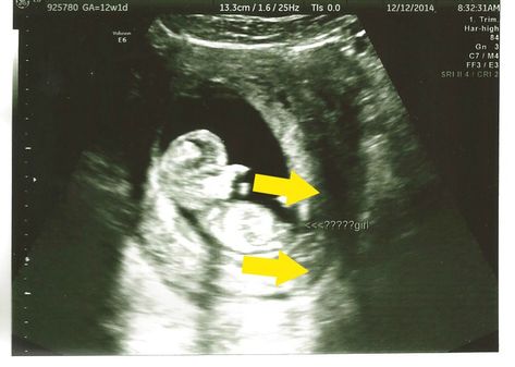 Is a 12 week ultrasound gender reveal possible? Can an ultrasound reveal gender at 12 weeks? Here's my experience with just that! 12 Week Ultrasound Gender, 12 Weeks Pregnant Ultrasound, Ultrasound Gender Reveal, Boy Ultrasound, 12 Week Ultrasound, 16 Weeks Pregnant Ultrasound, Ultrasound Reveal, Ultrasound Gender, Baby Ultrasound Pictures