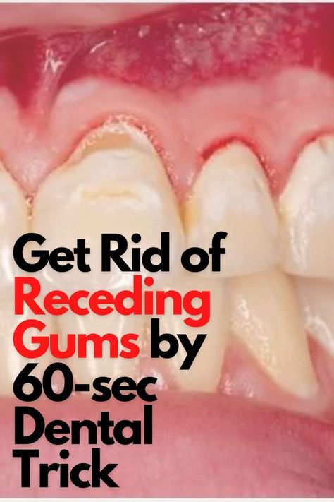 Learn How You Can Fix Your Bleeding Gums At Home. Best Strategy That Can Kill Every Other Method in the world. #gumcare #teethcare #teethcleaning #teethfixed #toothproblem #gumproblems Dental Hacks, Grow Back Receding Gums, Fix Teeth, Heal Cavities, Teeth Health, Receding Gums, Gum Care, Gum Health, Oral Health Care