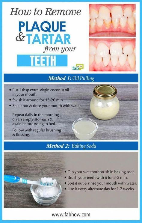 Get Rid of Cavities and Tooth Decay How To Remove Plaque, Tartar Teeth, How To Remove Warts, Remove Warts, Plaque Removal, Extra Virgin Coconut Oil, Stronger Teeth, How To Prevent Cavities, Oral Care Routine