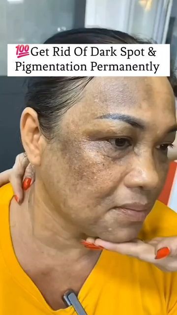 Skin Care For Dark Spots, Pigmentation On Face, Pigmentation Remedy, Face Recipes, Egg Face Mask, Dark Circles Around Eyes, Face Cleaner, Turmeric Mask, Turmeric Face