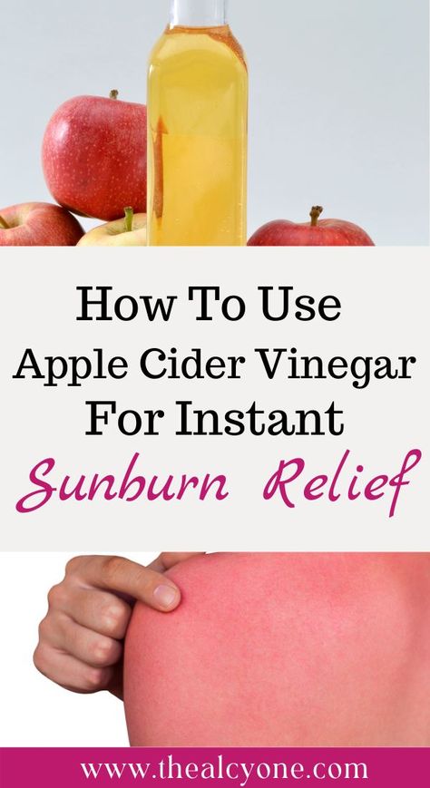 Apple Cider Vinegar Sunburn, Diy Sunburn Relief, Best Remedy For Sunburn, Vinegar For Sunburn, Best For Sunburn, Remedies For Sunburn, Home Remedies For Sunburn, Aloe Vera For Sunburn, Natural Remedies For Sunburn