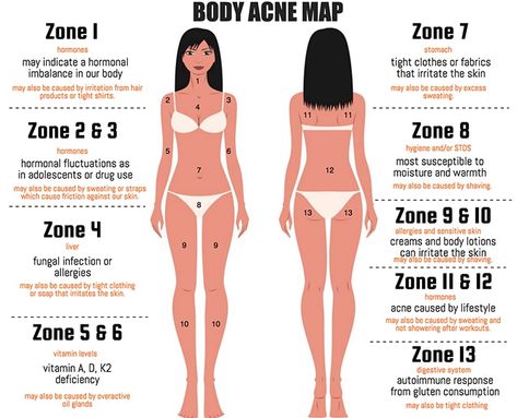 The Acne Map: What's The Meaning Behind Your Body Breakouts? - The Chalkboard Body Acne Map, Acne Map, Doterra Acne, Gesicht Mapping, Chest Acne, Face Mapping Acne, Face Mapping, Natural Acne, Body Acne