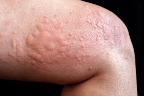 Talk With Your Doctor Many things can trigger chronic spontaneous urticaria (CSU), the name for itchy hives that happen almost every Hives Remedies, Chronic Hives, Types Of Acne, Autoimmune Disorder, Urgent Care, Skin Diseases, Itchy Skin, Dermatology, Skin Problems