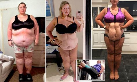 Woman left with 15lbs of saggy skin after losing 12st hopes to raise £17K to have it removed | Daily Mail Online Excess Skin, Saggy Skin, Gastric Bypass, Tummy Tucks, Daily Mail, Sports Bra, Bra, Skin, Health