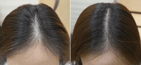 Vitamin C Is Being Used to Treat Thinning Hair and the Results Are Incredible - NewBeauty Thinning Hair Women, Treat Thinning Hair, Thining Hair, Thinning Hairline, Natural Hair Problems, Thinning Hair Remedies, Hair Problem, Make Hair Thicker, Hot Rollers Hair