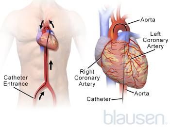 Heart Catheterization, Catheter Insertion, Enlarged Heart, Cardiovascular Disorders, Normal Heart, Parts Of The Heart, Heart Care, Heart Function, Coronary Arteries