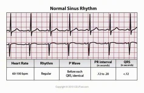 ECG - Normal Sinus Rhythm Cardiac Anatomy, Sinus Rhythm, Ekg Interpretation, Normal Sinus Rhythm, Cardiac Cycle, Ecg Interpretation, Nursing Fun, Nclex Review, Med Surg Nursing