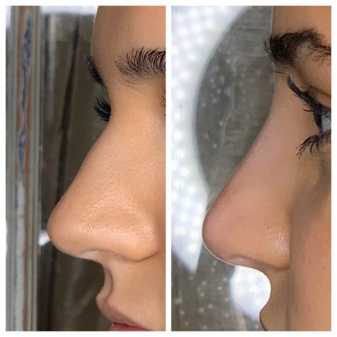 Straight Nose With Bump, Straight Nose Front View, Rhinoplasty Inspiration, Straight Nose Side Profile, Nose Filler, Smooth Nose, Nose Fillers, Straight Nose, Pretty Nose