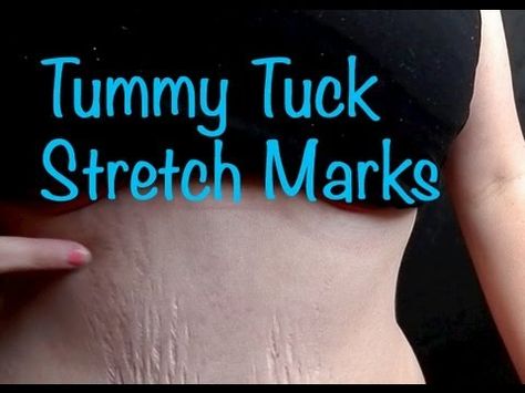 The much requested "stretch marks before and after tummy tuck" video is up! What I had before. What was removed. What I have now. And what... Mommy Makeover Recovery, Body Sculpting Surgery, Tummy Tucks Recovery, Mommy Makeover Surgery, Muscle Repair, Smooth Glowing Skin, Scar Cream, Drainage Massage, Stretch Mark Cream