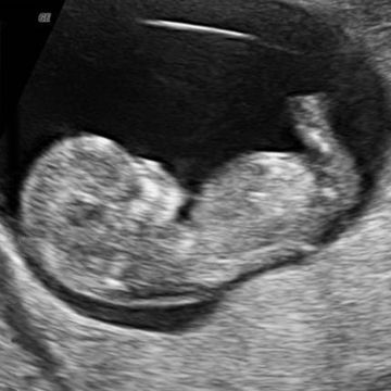 Fetal Size: Length, 1.61 inches; weight, 0.25 ounces. Fetal Development Milestones: Chin and neck are developing. Facial features are becoming more defined. Baby's ears move higher on the head. What You're Seeing: Baby-to-be is lying on her back with her head on the left side of the image and her legs pointing up. From this image, you can see that her neck is growing, separating her large head from the rest of her body. Her head still makes up more than 50% of 11 Week Ultrasound, 16 Weeks Pregnant Ultrasound, Baby Ultrasound Pictures, 11 Weeks Pregnant, 15 Weeks Pregnant, Trimester By Weeks, Sonogram Pictures, Pregnancy Ultrasound, Baby Ultrasound