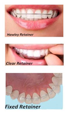 The most important thing after removing braces is preventing the teeth from shifting, in order to keep the teeth in place a retainer must be worn. However, when it comes down to choosing which type of retainer is best? Metal Retainers For Teeth, Clear Retainers After Braces, Retainers For Teeth, Retainers After Braces, Braces Removal, Teeth After Braces, Hawley Retainer, Braces Journey, Teeth Makeover