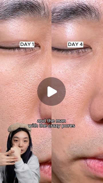 lily on Instagram: "if ur main skin concern is enlarged pores - i really think this could help! i was really shocked at the results after just 4 DAYS and we are still testing it so pls check back after a few weeks! and if u want to try the @nacificofficial.us fresh origin serum, its not available on oliveyoung so u have to get it on amazon!

#koreanskincare #koreanskincareroutine #koreanskincareproducts #kbeautyroutine #kbeautyblogger #koreanstyles #kpopstyle #skincareproduct #skincarehack #skincaretip" K Beauty Routine, Korean Skincare Routine, Enlarged Pores, Skin Serum, Skin Concern, K Beauty, Korean Skincare, Skin Care Tips, Get It