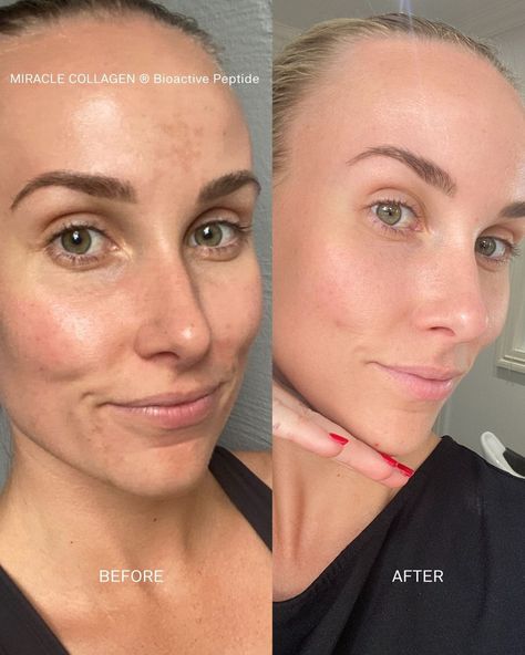 This is why we sold out—Miracle Collagen is truly transformative. The before and afters speak volumes. There’s nothing more rewarding than empowering our customers to feel confident and comfortable in their skin. August 11, Nothing More, Feel Confident, Confidence, Feelings, Skin, Quick Saves, Instagram