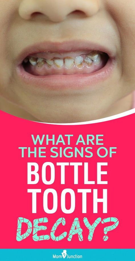 Nursing caries in infancy could damage deciduous teeth (milk teeth) and affect the eruption of permanent teeth. A dental checkup within six months of the first tooth’s eruption is advisable as a preventive measure. Fix Receding Gums, Home Remedies For Cavities, Baby Bottle Tooth Decay, Dental Business, Milk Teeth, Discolored Teeth, Kids Teeth, Clean Blackheads, Teeth Health