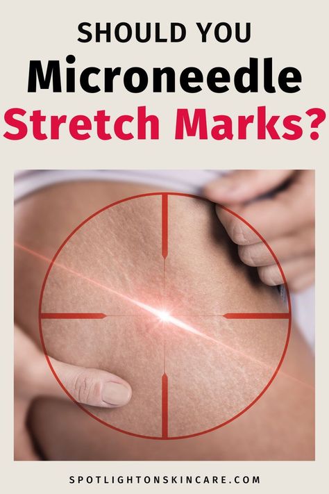 Shop the Best Stretch Mark Creams Now! 😘 stretch mark on neck, stretch mark on knee, stretch mark on hips #dryskin #wellnessmama #naturalremedies Stretch Mark Removal Before And After, Stretch Mark Microneedling, Dermarolling Stomach, Microneedling At Home, Best Stretch Mark Removal, Strech Marks, Marks Cream, Stretch Mark Removal, Stretch Mark Cream