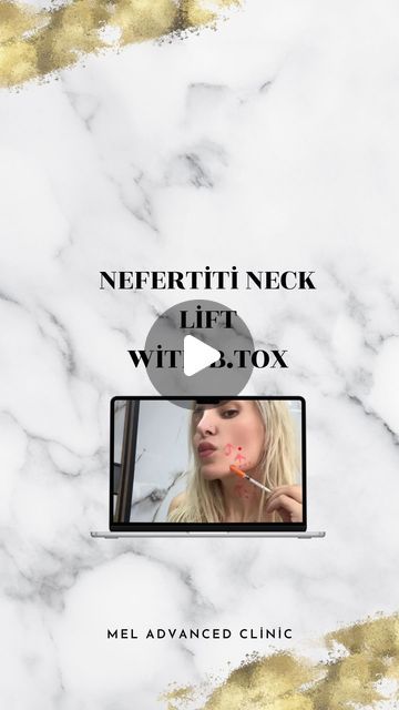 MELEK USLU Aesthetics & Facials & Laser Hair Removal & Academy on Instagram: "Nefertiti Neck Lift with B.TOX
#antiwrinkle #meladvancedclinic #antiwrinkletreatment" Aesthetics Facials, Anti Wrinkle Treatments, Neck Lift, Laser Hair, Laser Hair Removal, Anti Wrinkle, Hair Removal, Facial, Hair