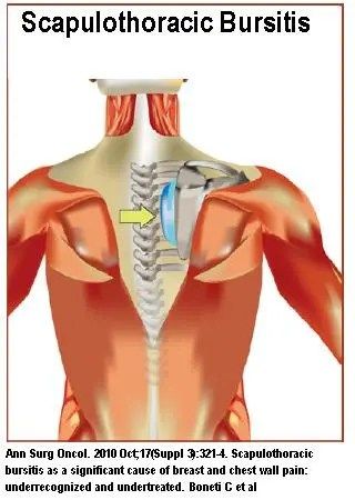 What is scapulothoracic bursitis (snapping scapula) syndrome - Arthritic Chick Subscapularis Stretch, Scapula Exercises Strength, Scapulohumeral Rhythm, Scapula Movement, Scapular Dyskinesis, Bursitis Shoulder, Muscle Atrophy, Shoulder Surgery, Body Ache