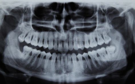 Panoramic dental Xray. Full mouth panoramic dental X-ray of a 29 year old male. , #AFFILIATE, #mouth, #panoramic, #ray, #Full, #Panoramic #ad Dental Panoramic X Rays, Dental Xrays, Dental X Ray, Dental Animation, Xray Art, Dental Images, Panorama Photography, Medical Animation, Dental Anatomy