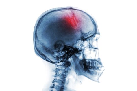 New research in Oxford could lead to improvements in recovery of stroke survivors Types Of Strokes, Brain Surgeon, Brain Stimulation, Brain Connections, Improve Cognitive Function, Brain Damage, Brain Fog, Blood Vessels, Dental Care