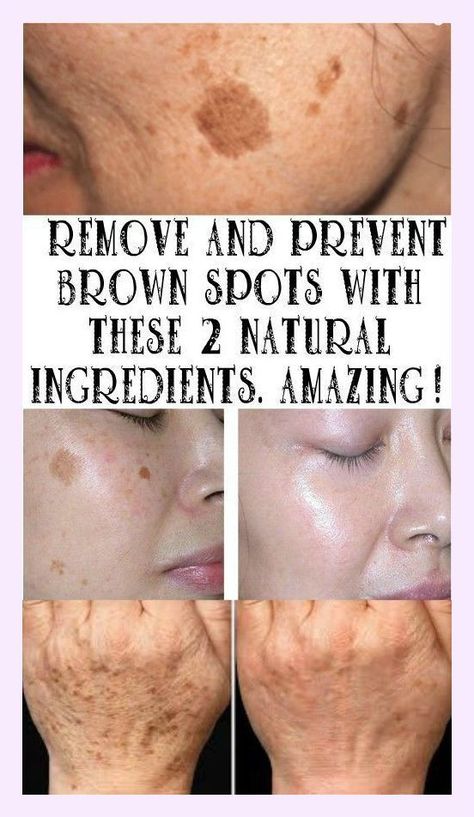 Brown Spots On Skin, Brown Spots Removal, Brown Spots On Face, How To Get Rid Of Pimples, Skin Spots, Spots On Face, Baking Soda Shampoo, Brown Spots, Skin Issues