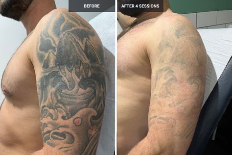 Witness astonishing changes with laser tattoo removal before and after. Discover the journey to tattoo-free skin. - #Beforeandaftertattooremoval #Comparingtattoobeforeandafterremoval #Comparisonoftattooappearance #Evolvingtattooappearance #Lasertattootransformation #Progressionoftattooerasure #Tattoochangefromstarttofinish #Tattoodisappearancetransformation #Tattoofadingprogress... Laser Tattoo Removal Before And After, Tattoo Removal Before And After, Tattoo Free, Tattoo Removal Cost, Tattoo For Boyfriend, Tattoo Minimal, Sketches Ideas, Web Tattoo, Omerta Tattoo